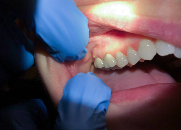Best Emergency Root Canal Treatment in Berwick, LA