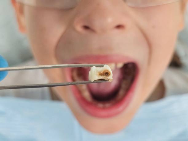 Best Emergency Dental Care for Broken or Chipped Teeth in Berwick, LA